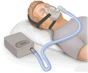 CPAP Equipment